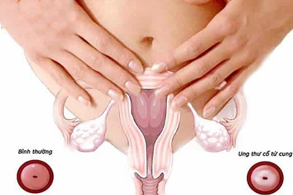 Ung thư cổ tử cung là bệnh phụ khoa nguy hiểm chỉ đứng sau ung thư vú